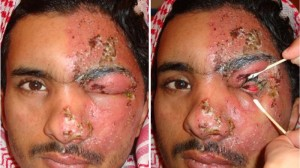 Illustration for article titled Pengobatan Penyakit Herpes Secara Tradisional